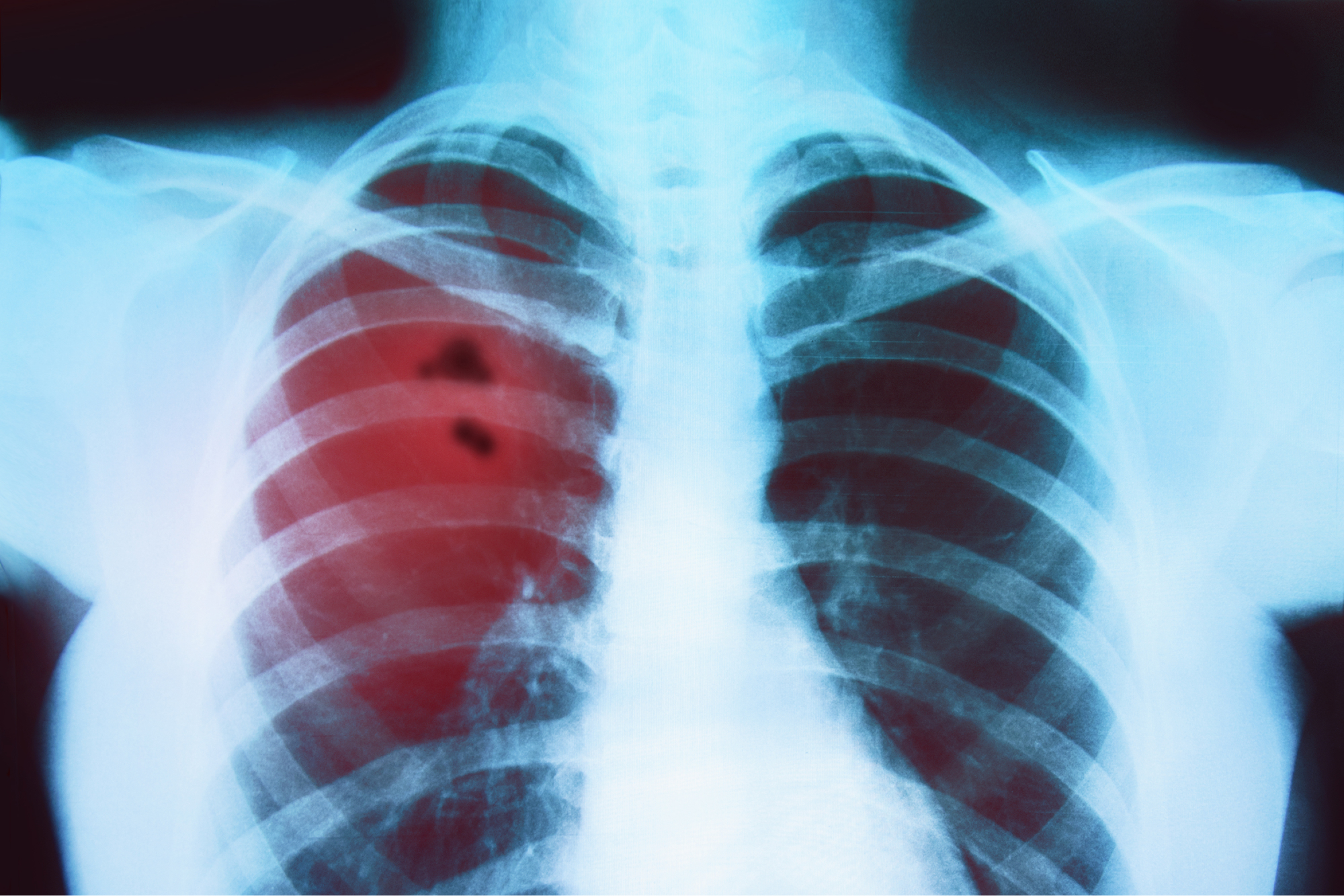 Building Urgency to Diagnose and Treat Lung Cancer
